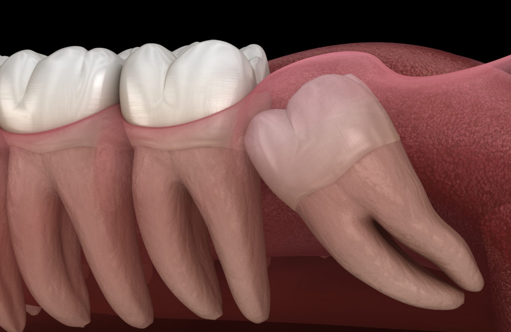 Ouch! Wisdom teeth extractions - Lane Oral Surgery - Plymouth, MA and Sandwich, MA