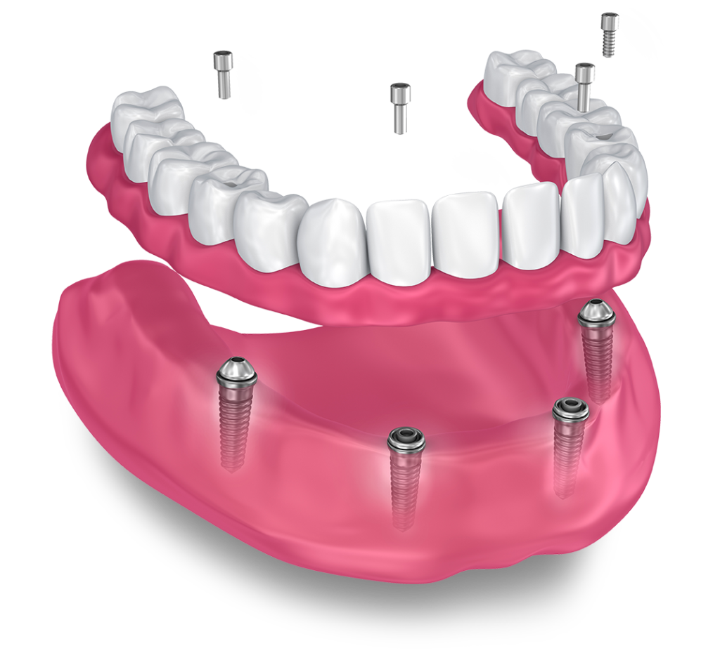 Snap On Solution- Lane Oral Surgery - Plymouth, MA and Sandwich, MA