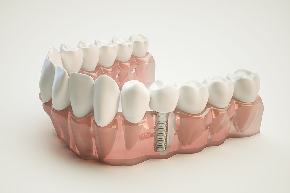 Dental Implant - Lane Oral Surgery - Plymouth, MA and Sandwich, MA