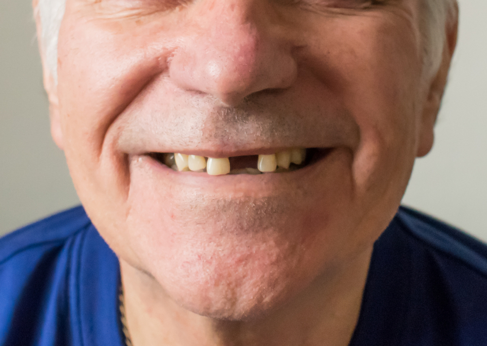 4 huge risks of not replacing missing teeth