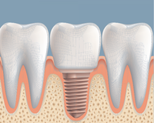 dental implant success