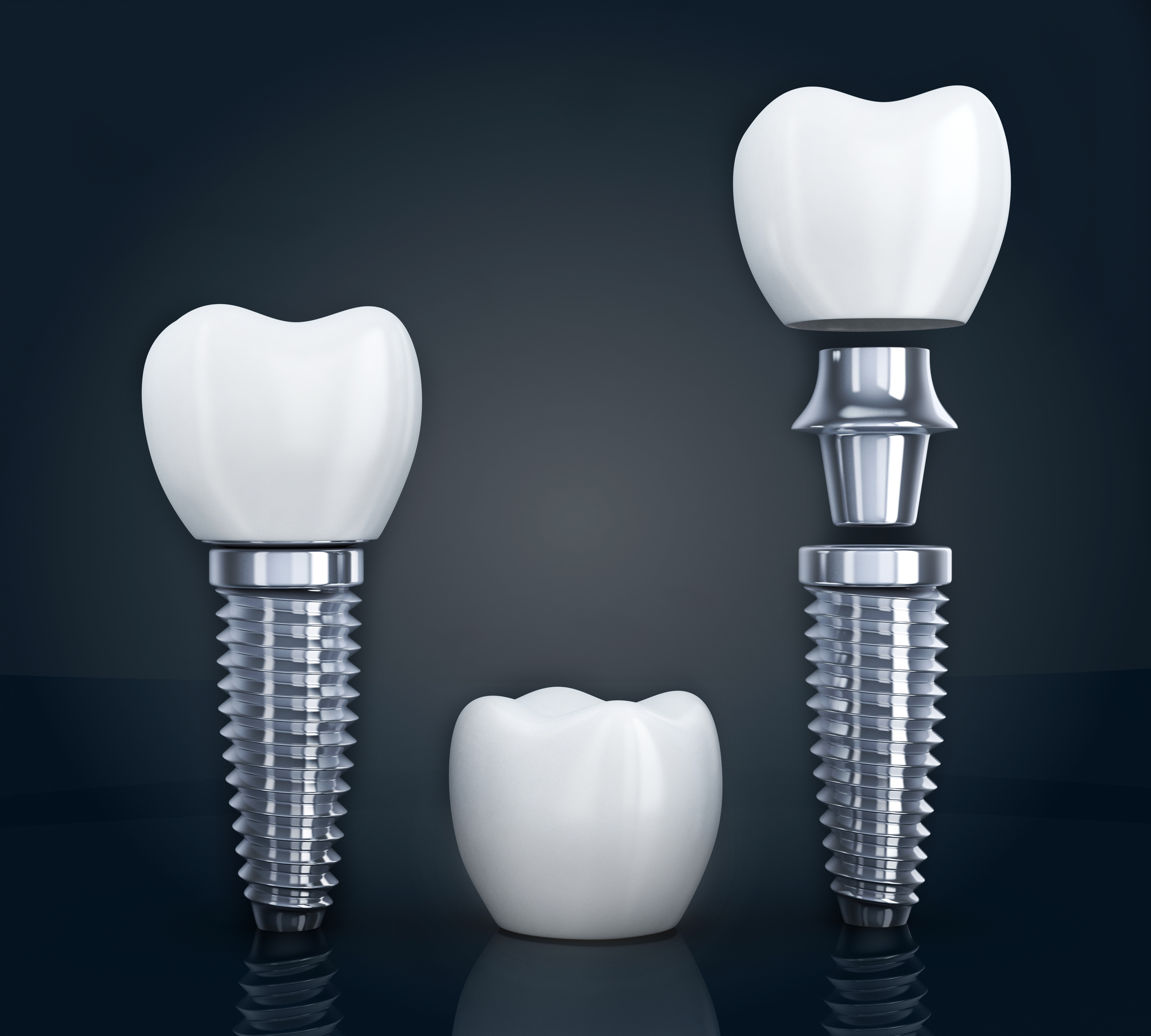 Dental Implant