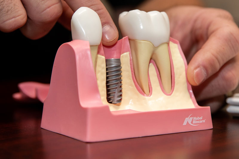 Dental Implant Graphic