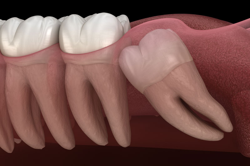 How to get rid of hiccups after wisdom teeth surgery