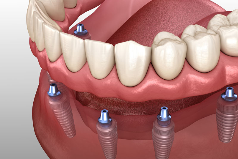 Implant Supported Dentures