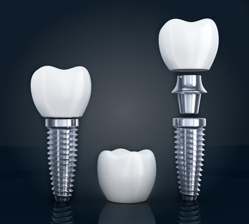 the three different parts of a dental implant; the crown, the abutment and the titanium post