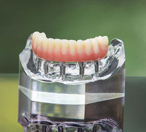 a model of full arch dental implants
