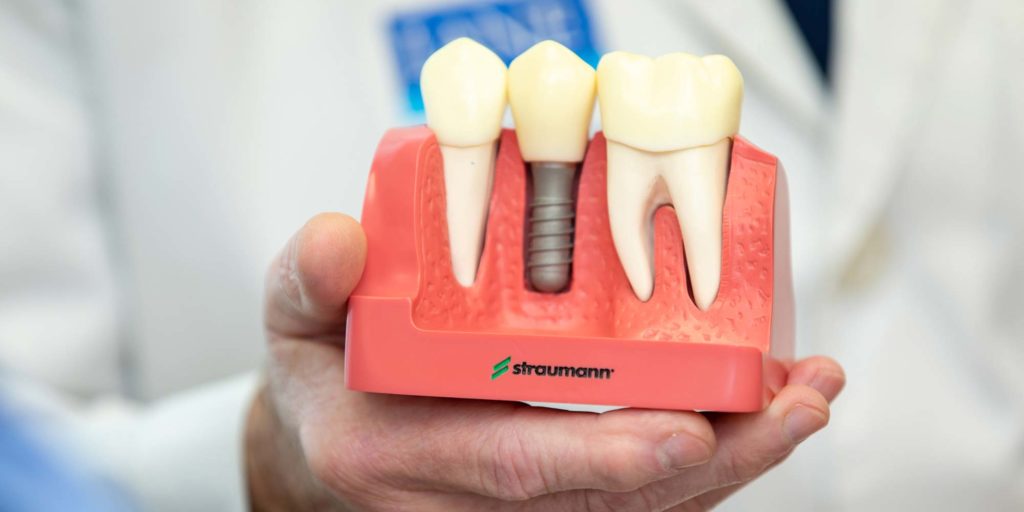 a Straumann dental implant model