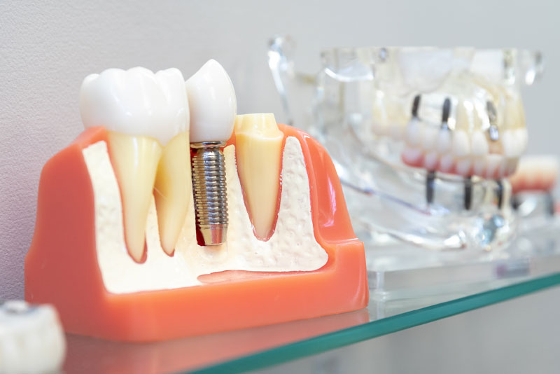 Dental Implant Model Graphic