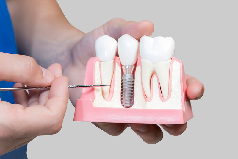 Dental Assistant Showing Off A Dental Implant In A Jawbone Cutaway Model in Sandwich, MA
