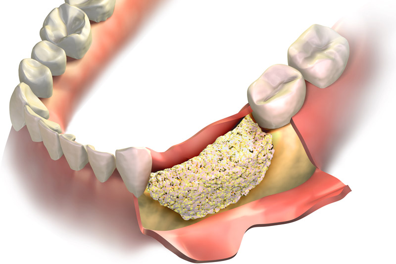 a diagram depicting a placed bone graft