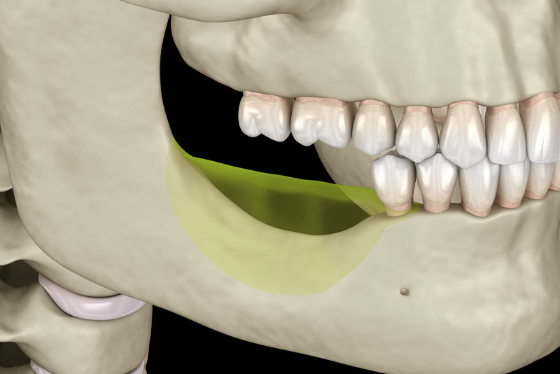 a graphic showing jaw bone loss on the lower jaw