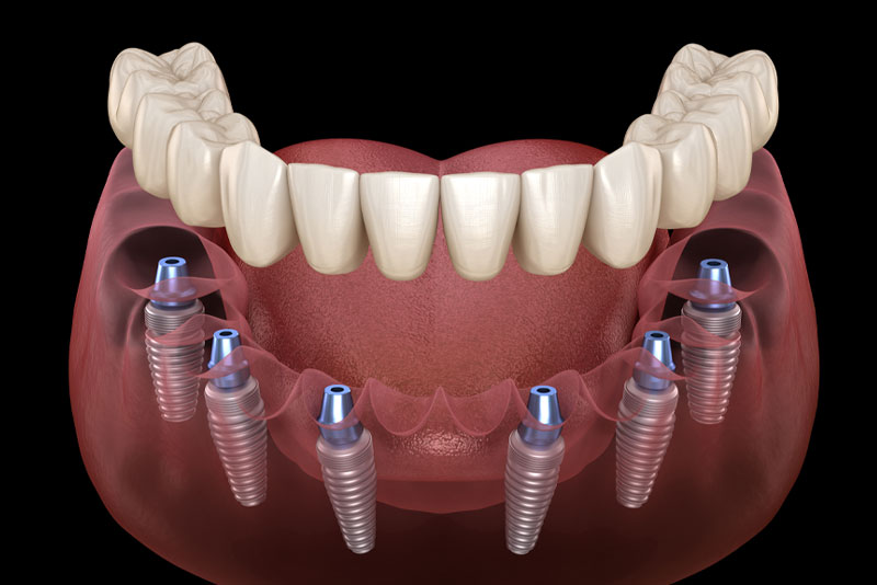 a full mouth dental implant model showing 6 dental implant posts planted in the gum under dental crowns