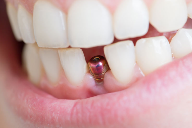 a picture of a dental patients smile after an oral surgeon has placed a dental implant post in the patients lower arch, surrounded by natural teeth.