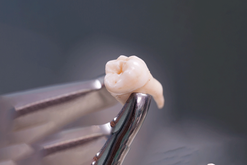 a wisdom tooth after being extracted.