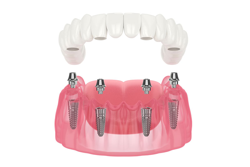 a digital model of a full mouth dental implant prosthetic.