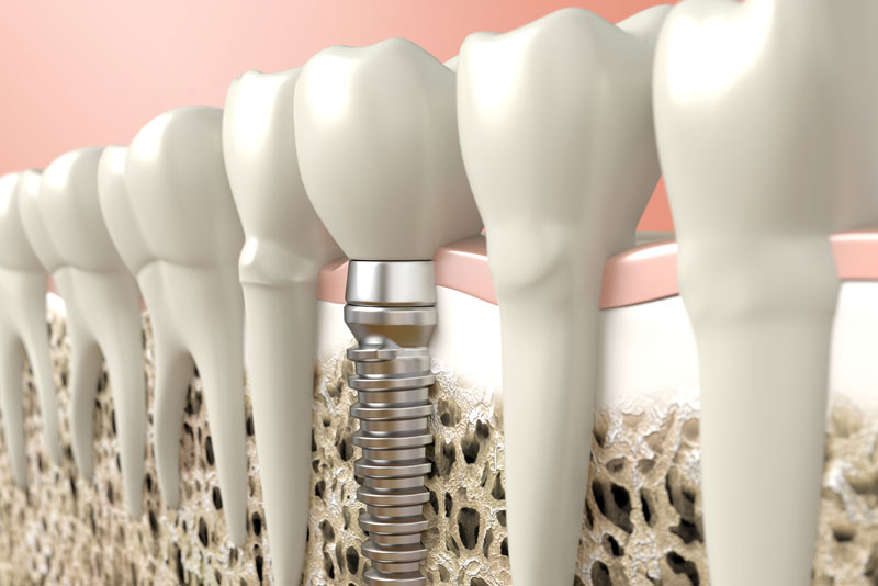 An image of a dental implant model.