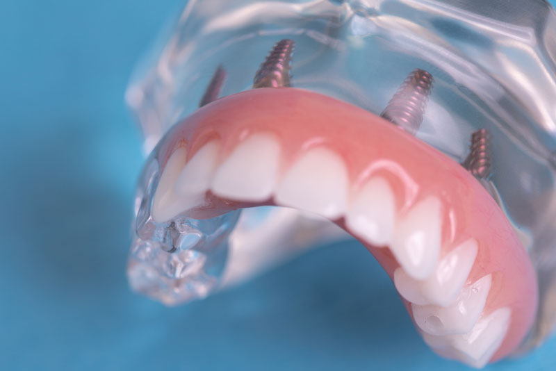 a full mouth dental implant model that can show patients how their smile can be restored with full mouth dental implants after getting their teeth extracted.