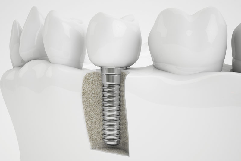 a bone grafting site that shows a dental implant placed in it and it is surrounded by natural teeth.