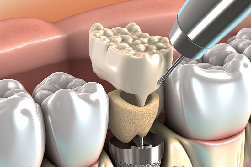 a digital model showing the dental implant post and crown.