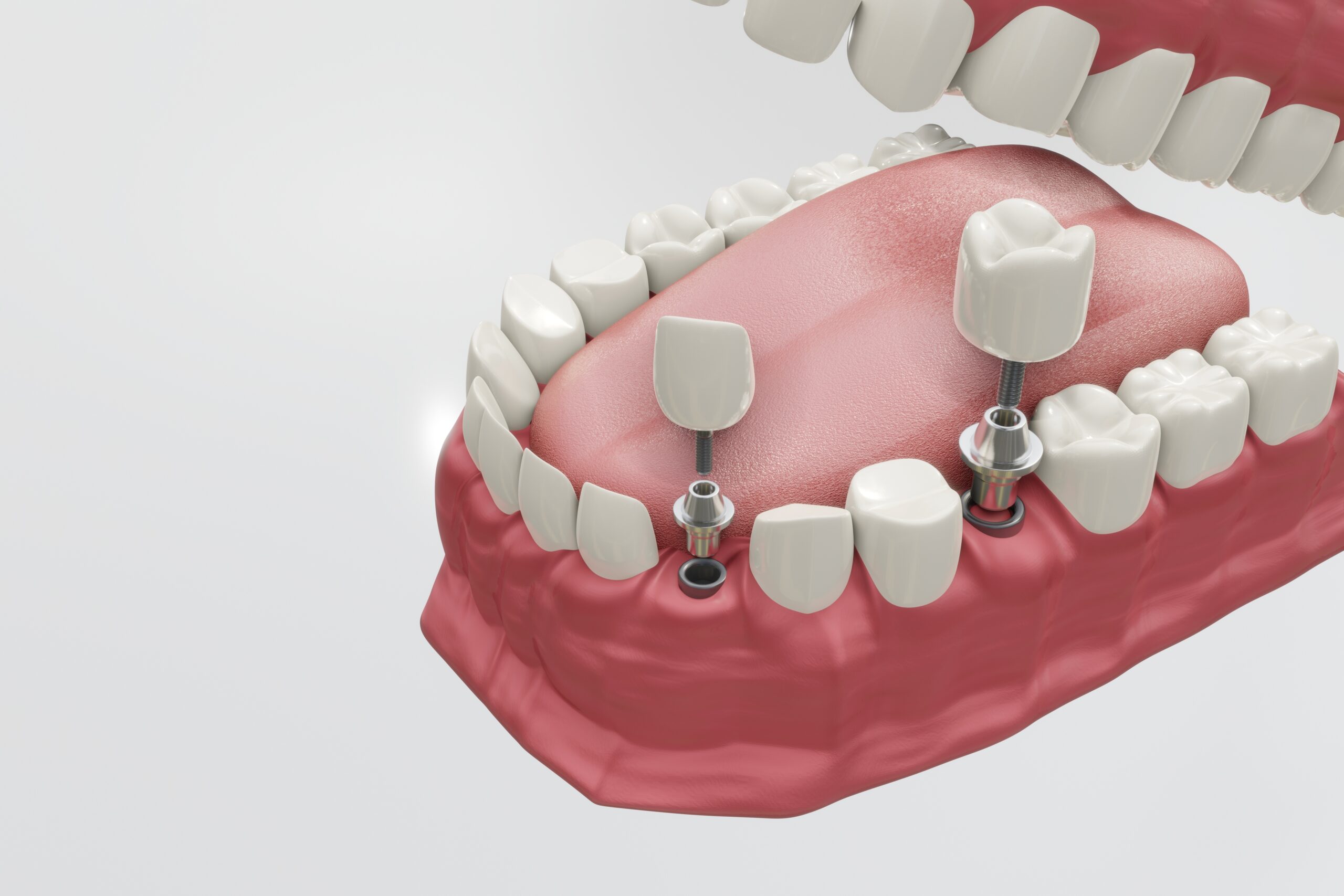 a 3D image of dental implants.