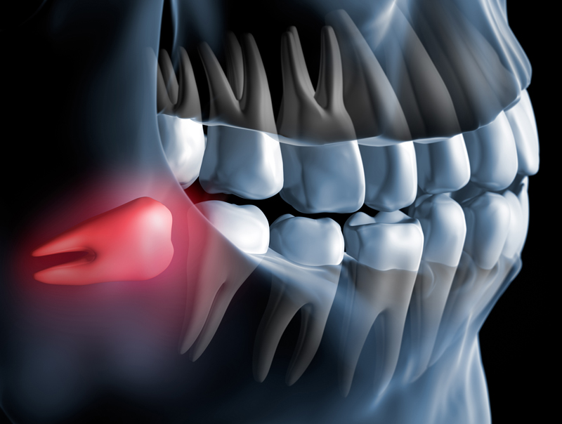 3d model xray of a wisdom tooth causing pain.