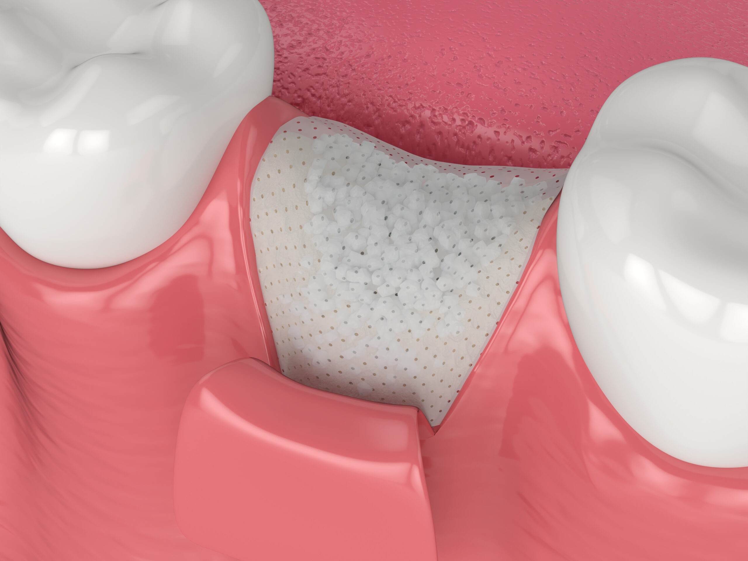 3D render of dental bone grafting with bone biomaterial and membrane over white background. Jaw bone augmentation concept.