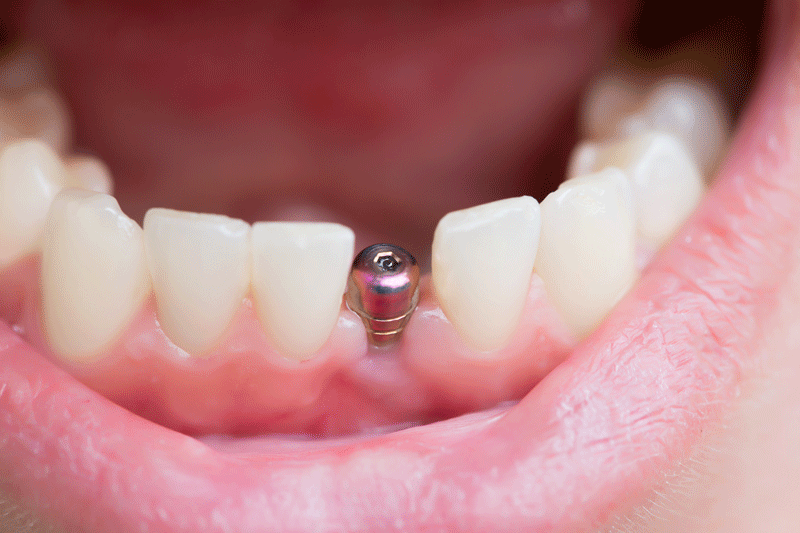 close up shot of a patient’s mouth with a single implant