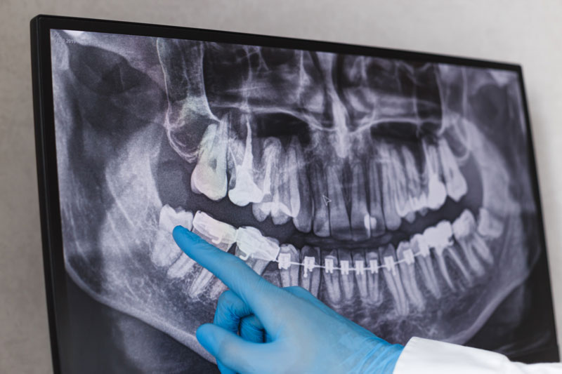 an x-ray image of an impacted wisdom tooth.
