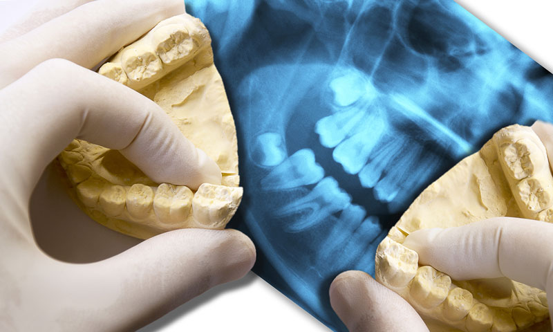 Dentist holding two jaw models at the wisdom tooth position with a Xray in the background.