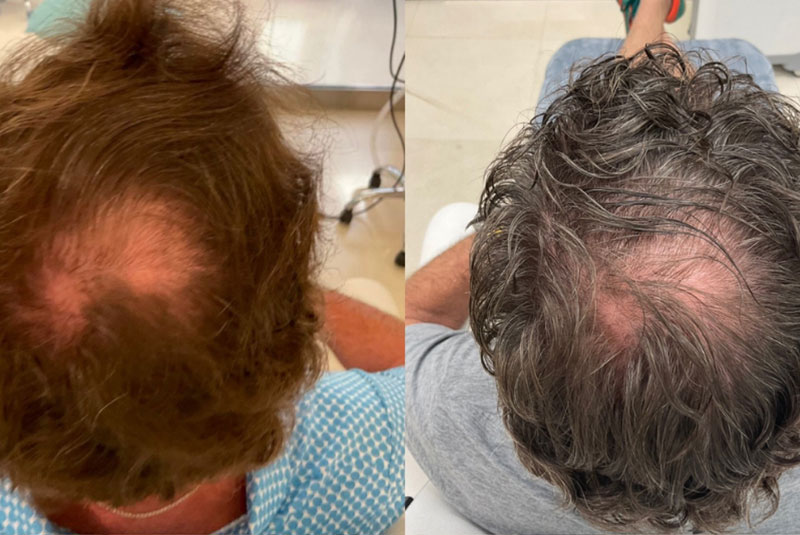 Before and after of PRF Treatment