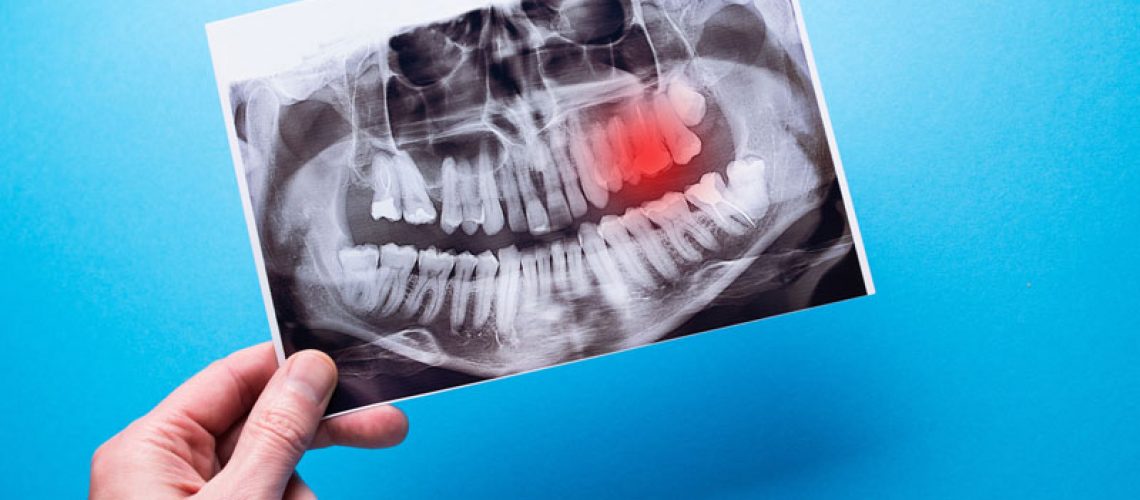 A dentist points to a problem area on a dental X-ray, highlighted in red. Concept of toothache and dental examination.