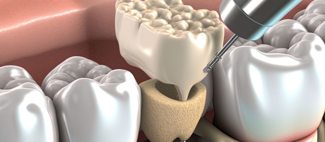a digital model showing the dental implant post and crown.