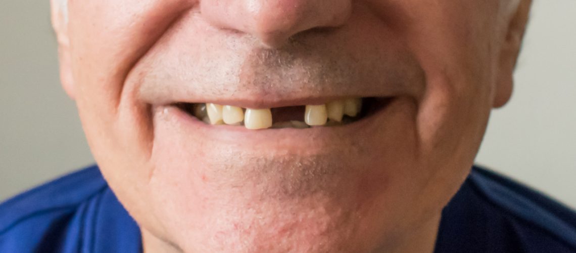 4 huge risks of not replacing missing teeth