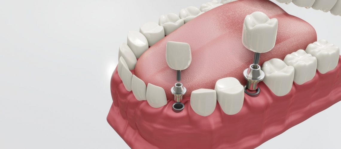 a 3D image of dental implants.