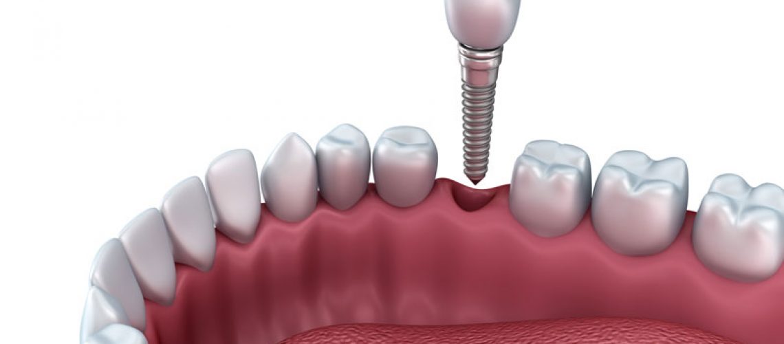 a dental implant model showing how the dental implant post, abutment, and crown are placed in the patients gums during their dental implant procedure.