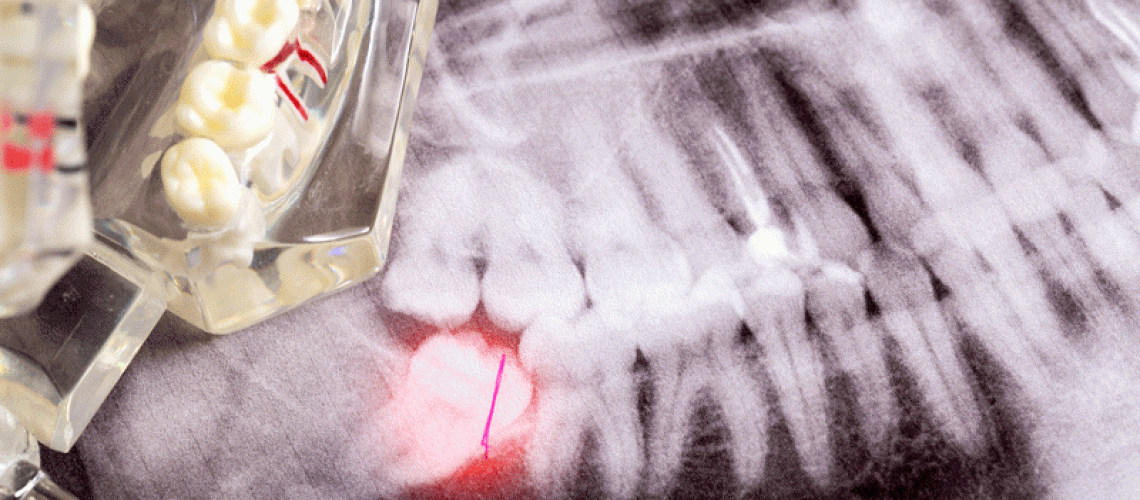 Impacted wisdom teeth on an X-ray picture with an inflamed cyst neoplasm. Removal of wisdom teeth in dentistry.