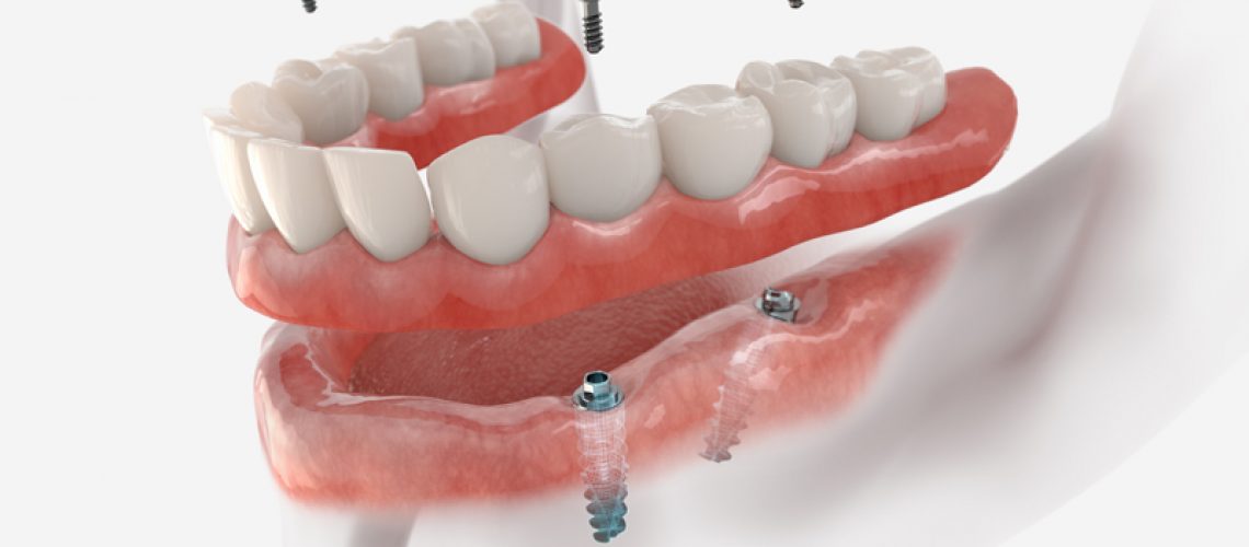 3d Image of a full bottom mouth dental implant denture.