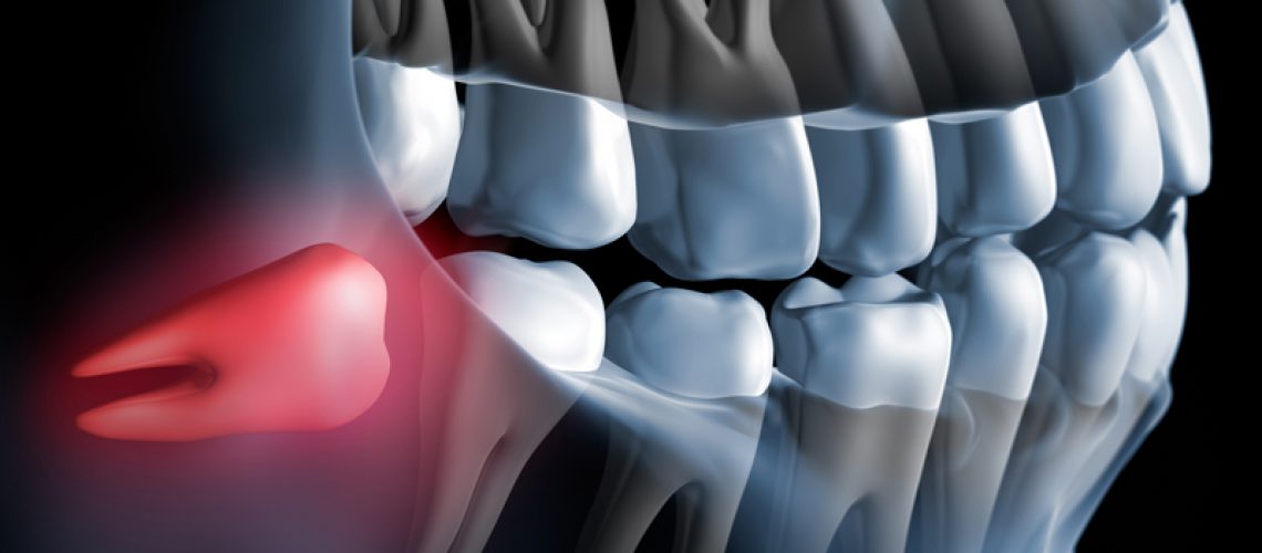 3d model xray of a wisdom tooth causing pain.