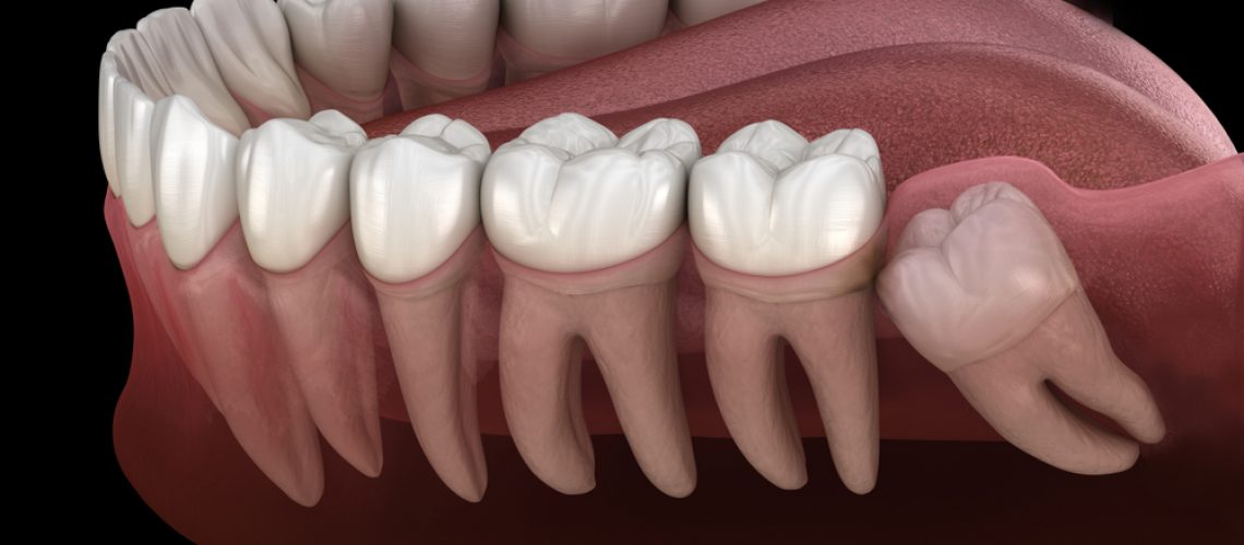 about impacted teeth