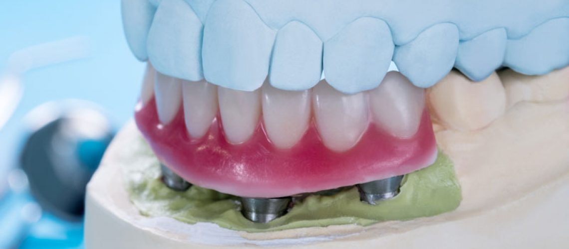 an implant supported denture model all on four implant posts.