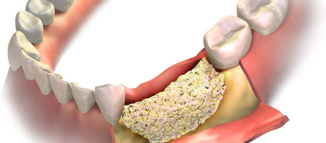 a diagram depicting a placed bone graft