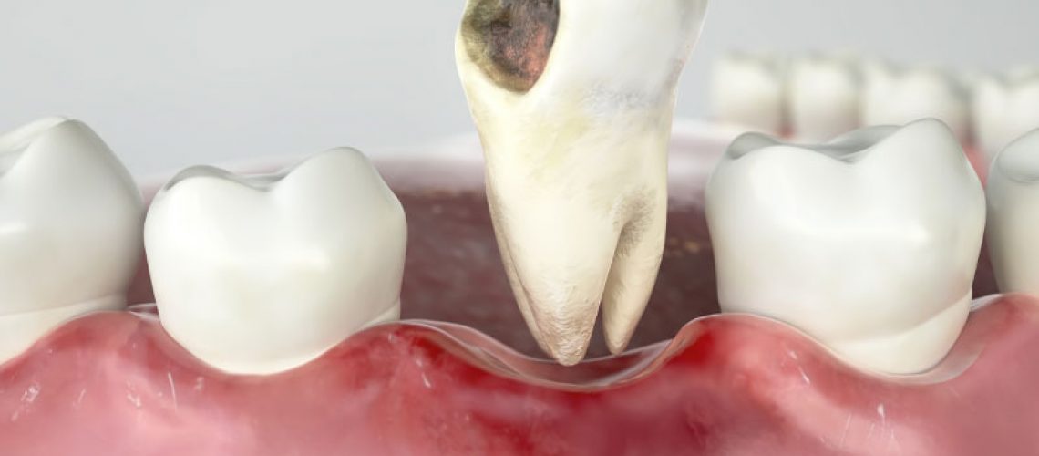 an image of a tooth being extracted.
