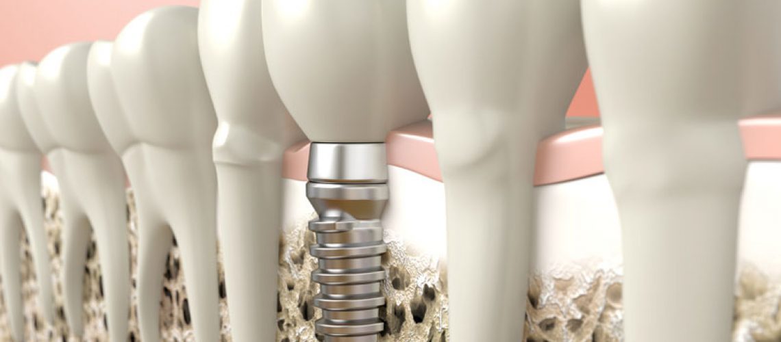 An image of a dental implant model.