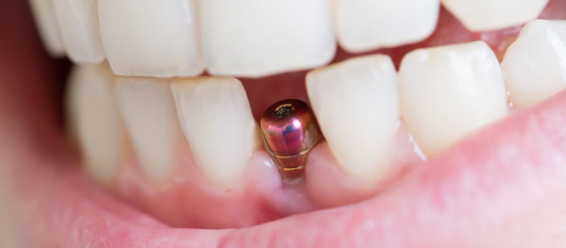 a close up picture of a patients smile showing a dental implant post placed in the gums where they had their bone grafting procedure aided with PRP for a faster procedure experience.