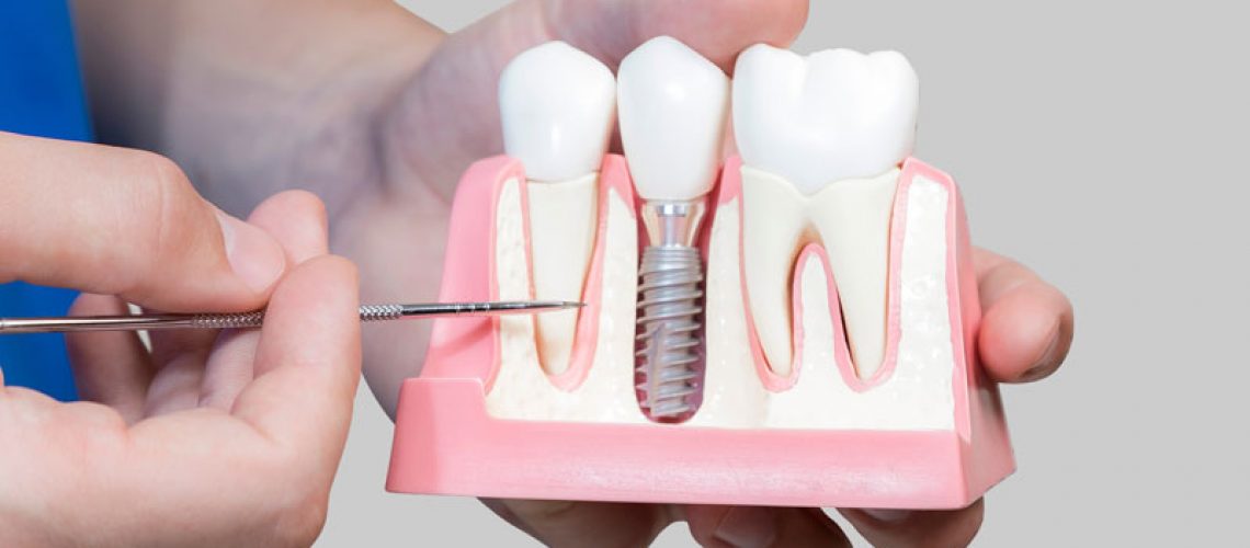 Dental Assistant Showing Off A Dental Implant In A Jawbone Cutaway Model in Sandwich, MA