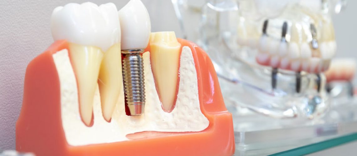 Dental Implant Model Graphic