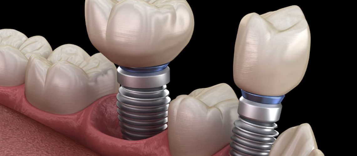 Dental Implants Model