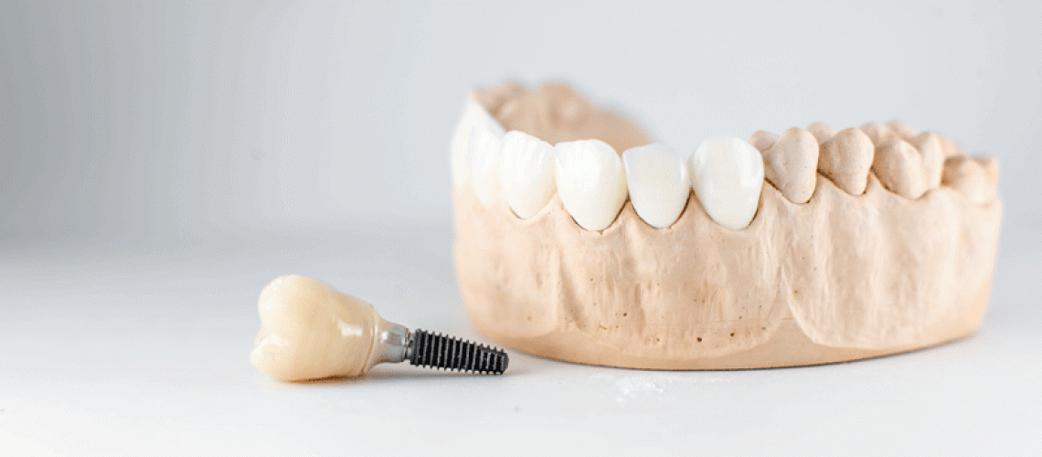 Dental implant in front of lower mouth model