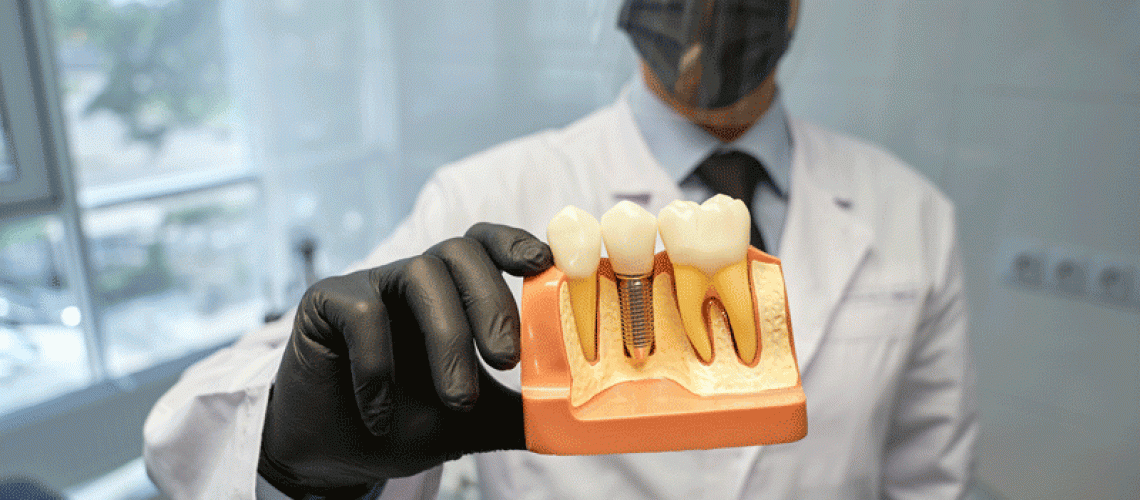 Doctor holding a model of a dental implant